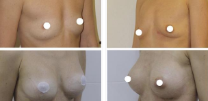 zväčšenie prsníkov (augmentácia
