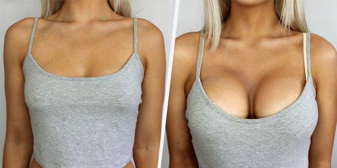 pred a po plastickej chirurgii na zväčšenie prsníkov