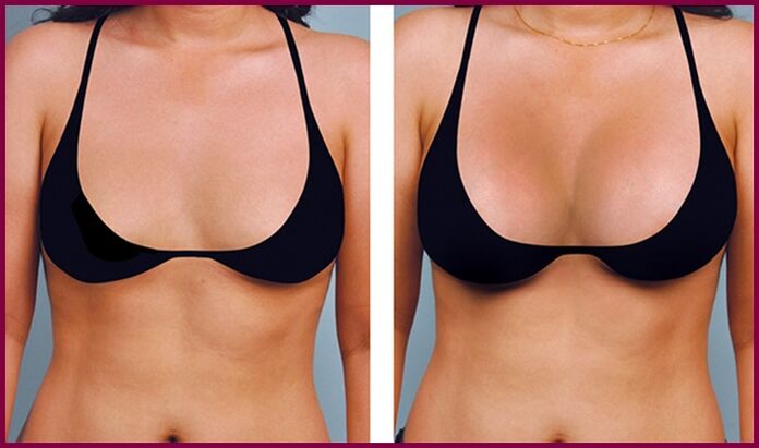 pred a po augmentácii prsníkov tukom