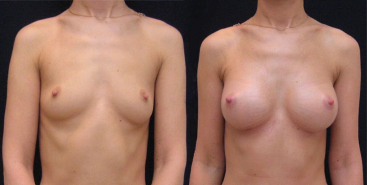 prsníka pred a po endoskopickej augmentácii