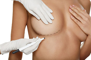 Značenie značkou pred operáciou zväčšenia prsníkov